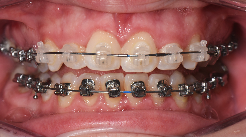 What You Need to Know About Rubber Bands and Braces